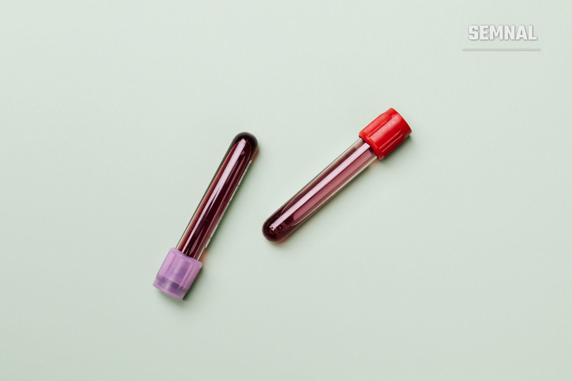 Două tuburi medicale de colectare sânge cu dopuri colorate (violet și roșu) conținând probe de sânge pentru testare laborator, utilizate în diagnosticul deficitului de fier.