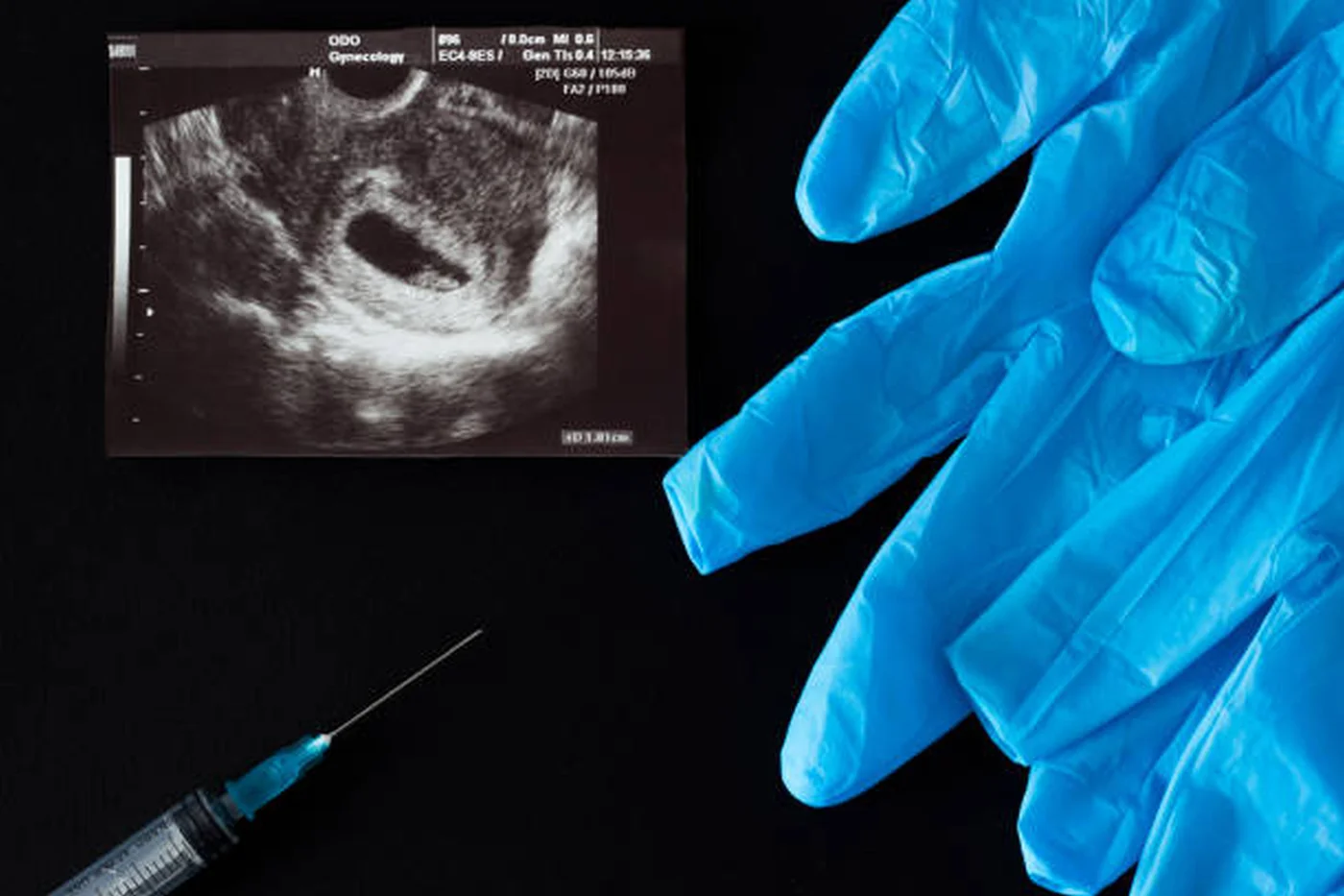 Dezinformări despre avort: experimentul Ilincăi Urse