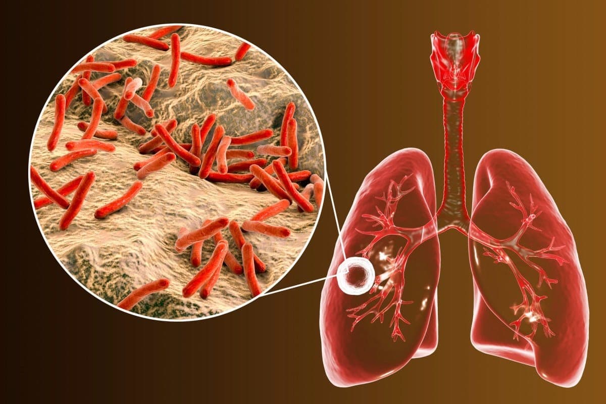 Tuberculoza pulmonara