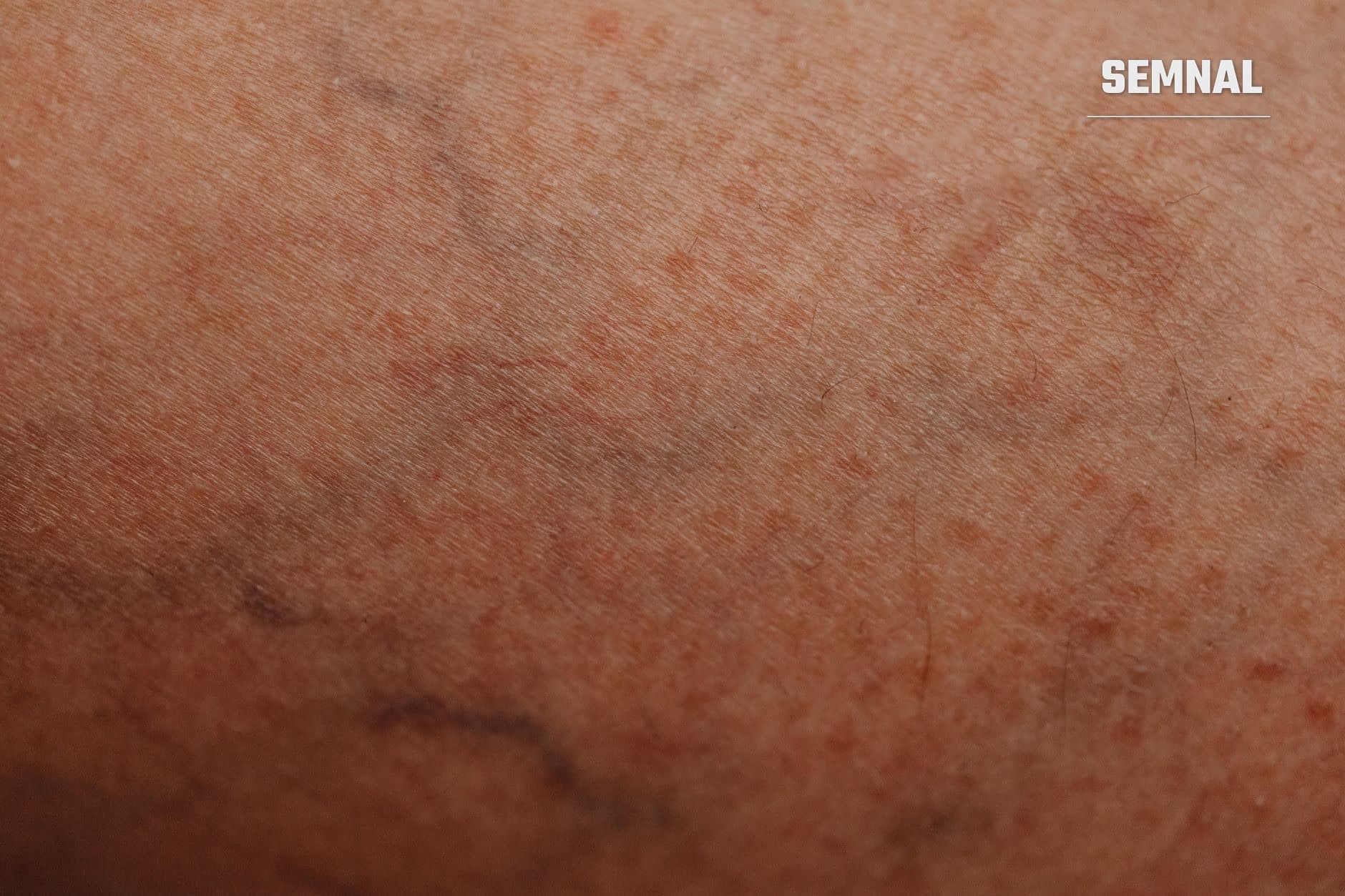 Detaliu macro al pielii unui antebraț, arătând textura și pigmentarea naturală a epidermei cu nuanțe roz-brun și mici variații de culoare pe suprafață. (Foto: https://kaboompics.com/ / Pexels)