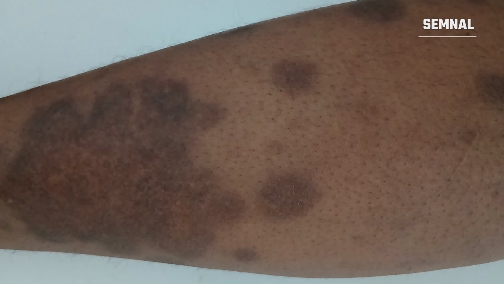 Gambă a unui pacient cu piele închisă la culoare, cu plăci de psoriazis de nuanță mai întunecată, fotografiată pe fundal deschis