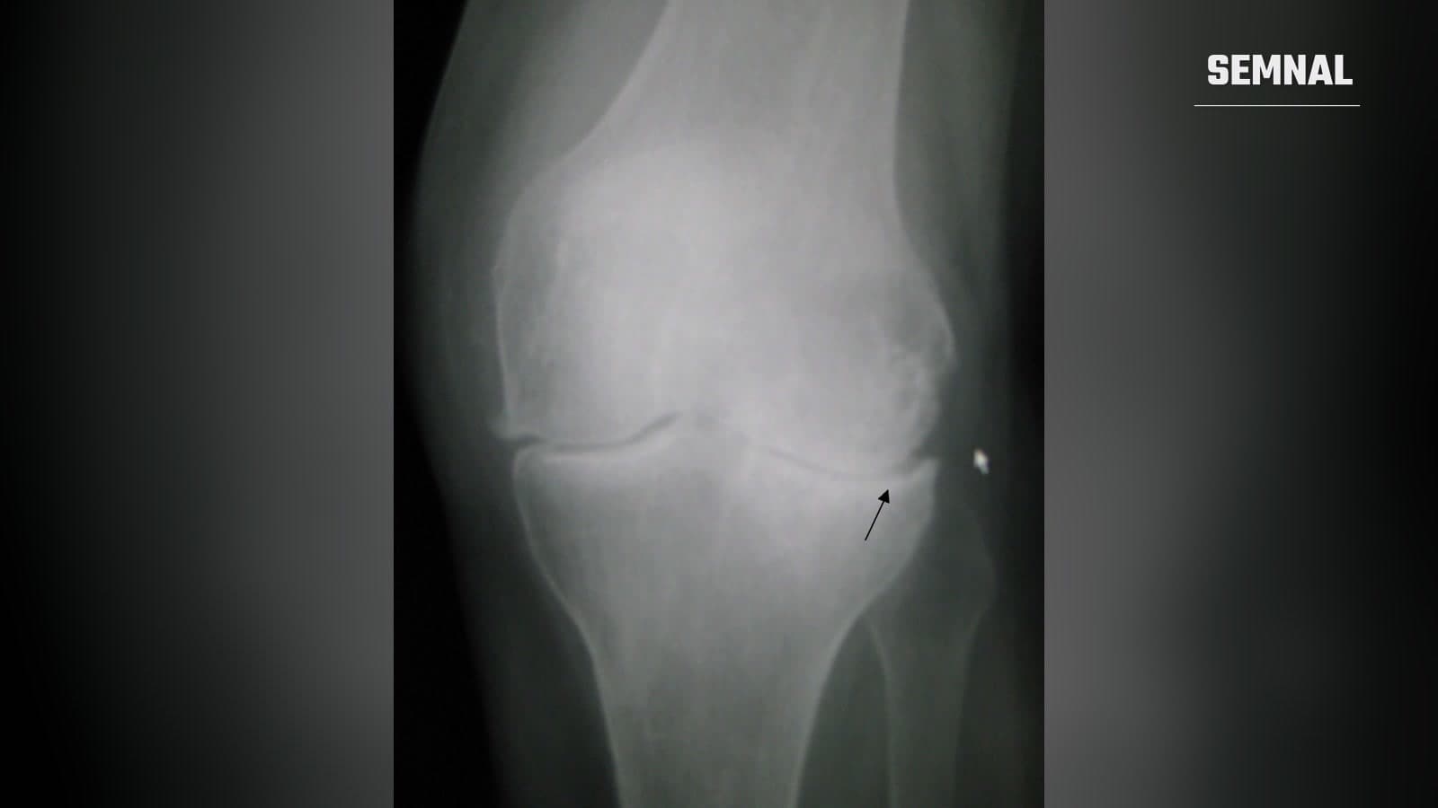 Radiografie a unui genunchi cu artroză, cu spațiul articular îngustat indicat de o săgeată