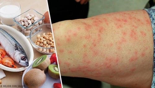 Alergie Alimentara