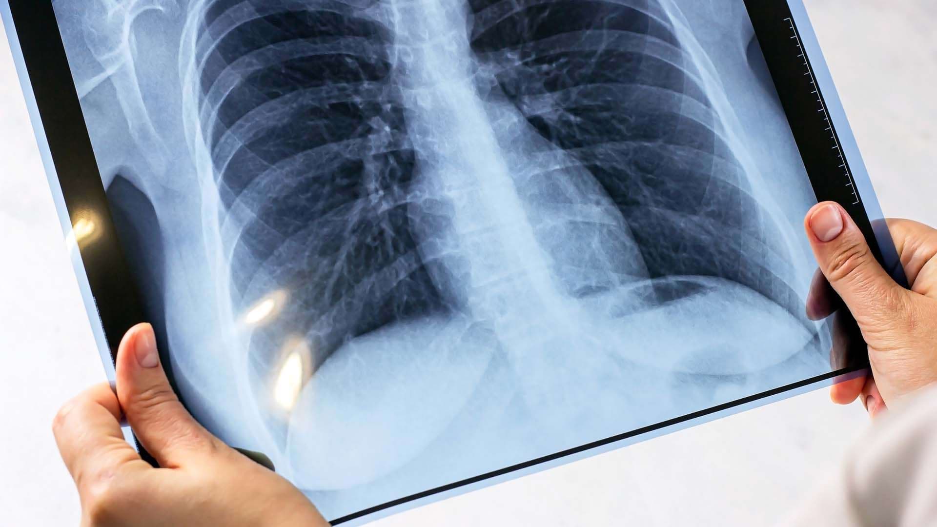 Tuberculoza