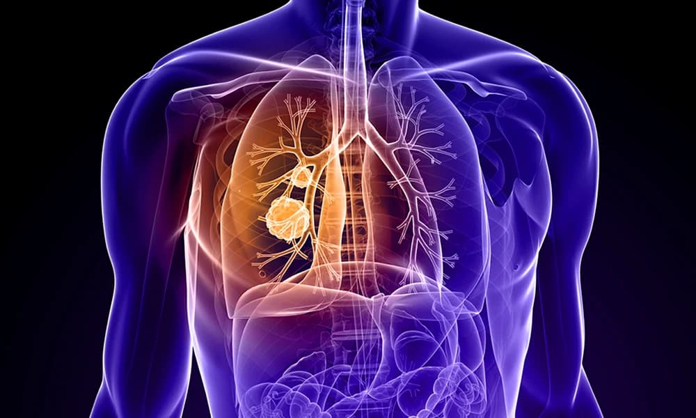 Primul vaccin experimental împotriva cancerului pulmonar intră în testare clinică în Marea Britanie — Internațional